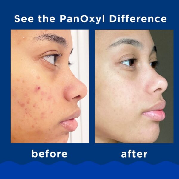 PanOxyl, Acne Creamy Wash Benzoyl Peroxide 4% Daily Control 170g - Image 2